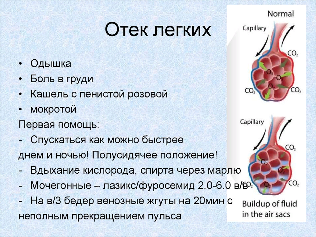 Вода в легких причины и лечение. Из за чего происходит отек легких у человека.