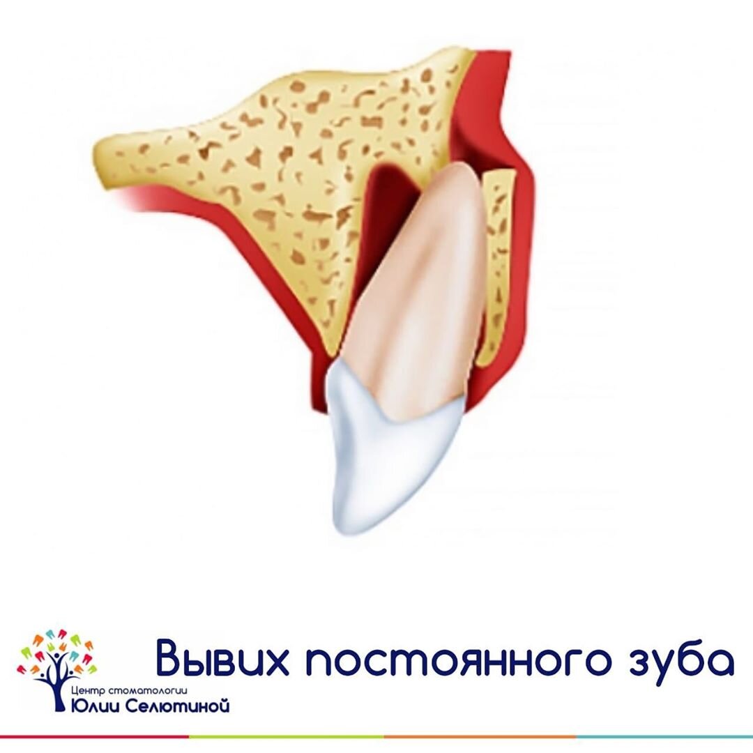II. Перелом зуба.