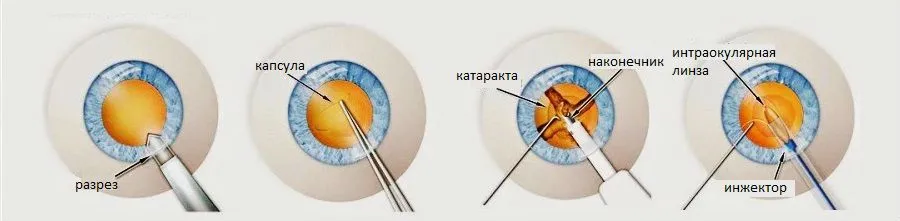 Операция факоэмульсификация катаракты. Ультразвуковая факоэмульсификация катаракты. Факоэмульсификация катаракты с имплантацией интраокулярной линзы. Операция ультразвуковая факоэмульсификация катаракты. Что можно делать после катаракты