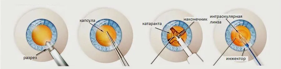 Замена хрусталика при катаракте. Факоэмульсификация катаракты с имплантацией интраокулярной линзы. Факоэмульсификация катаракты этапы. Схема операции по замене хрусталика глаза. Факоэмульсификация катаракты этапы операции.
