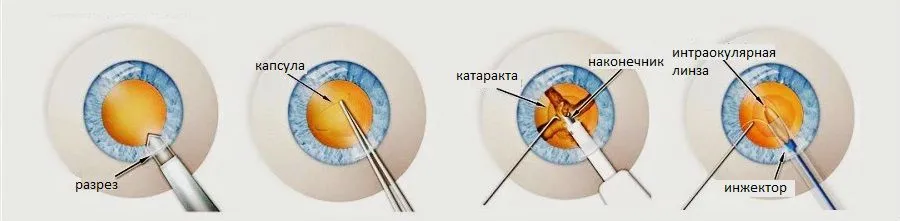 После операции катаракты можно. Факоэмульсификация катаракты с имплантацией интраокулярной линзы. Факоэмульсификация катаракты этапы. Схема операции по замене хрусталика глаза. Факоэмульсификация катаракты этапы операции.