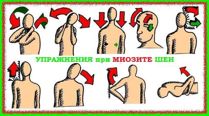 Инфекционные болезни мышц. Воспаление мышц миозит. Упражнения при миозите шеи. Шейный миозит симптомы.