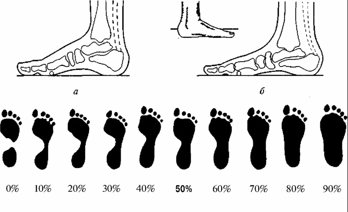 Как определить стопы. След стопы 2 степень плоскостопия. Плоскостопие вид сбоку. След стопы 1 степень плоскостопия. Степень плоскостопия по отпечатку стопы.