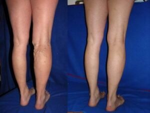 Хирургическое вмешательство может быть проведено на любой стадии варикоза. Современные методы позволяют избавиться от проблемы быстро, эффективно и безопасно.