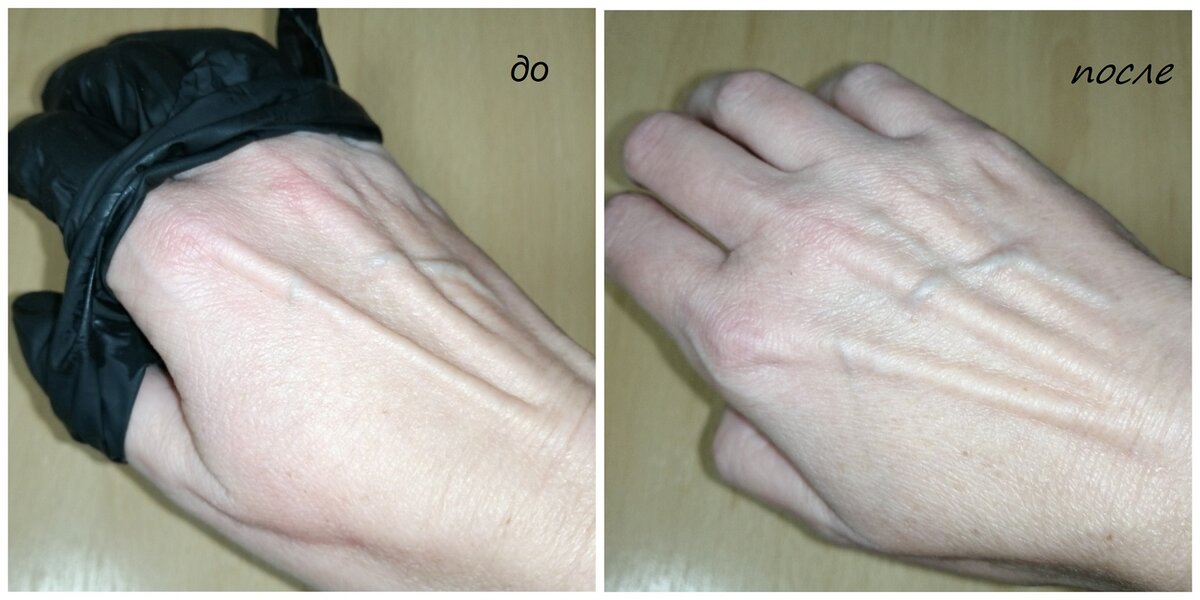 Еле дождалась момента когда можно снять перчатки, даже не сняла их а разорвала. Фотография к сожалению плохо передаёт всей удручающей картины на руках во время снятия перчаток, а вот, на второй отчётливо видно, что краснота спала. Разница по времени фотографий составляет не более 15 минут.  
