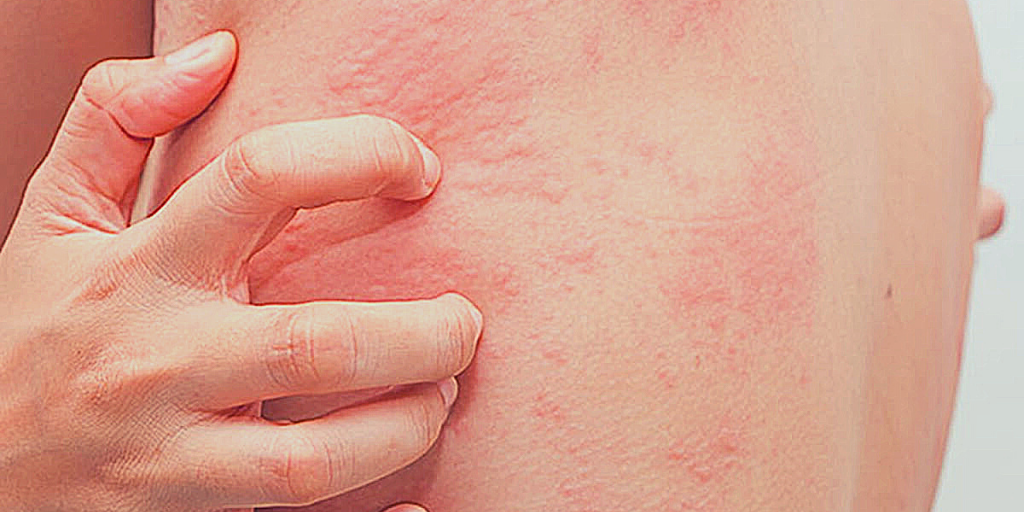 Аллергическая реакция на лекарство.Зуд.