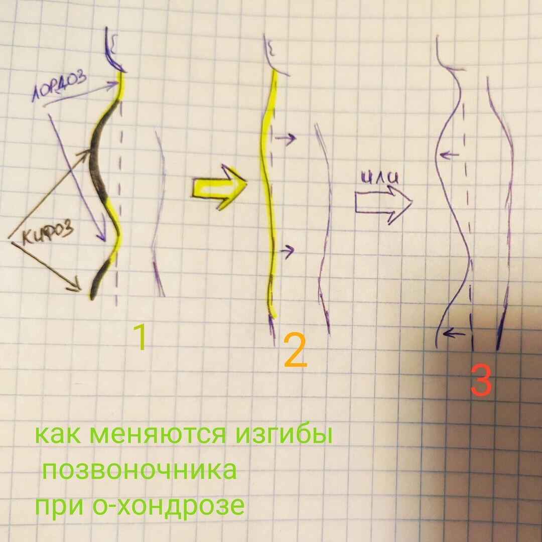 как меняются изгибы позвоночника при остеохондрозе