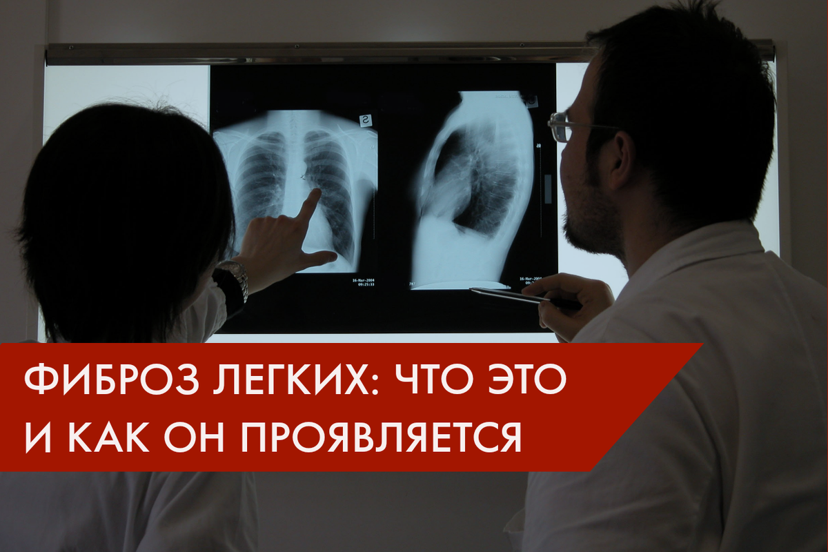Фиброз легких: что это такое, почему он возникает и что с ним делать ...