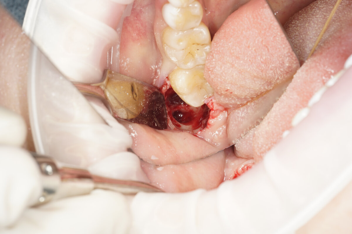 Лунка после атравматичного удаления