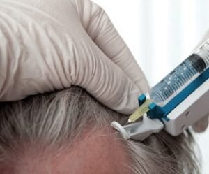 Составы для мезотерапии проникают глубоко в слои кожи, способствуют нормализации обменных процессов. Интересно, что процедура оказывает положительное влияние не только на волосы, но на весь организм в целом.