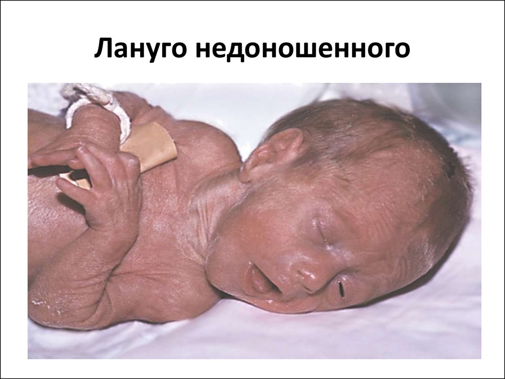  Лануго чаще замечаются у недоношенных новорожденных
