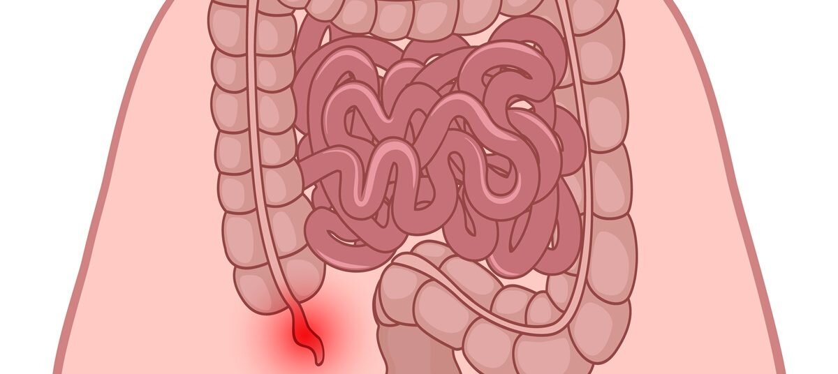 Аппендицит картинка человека