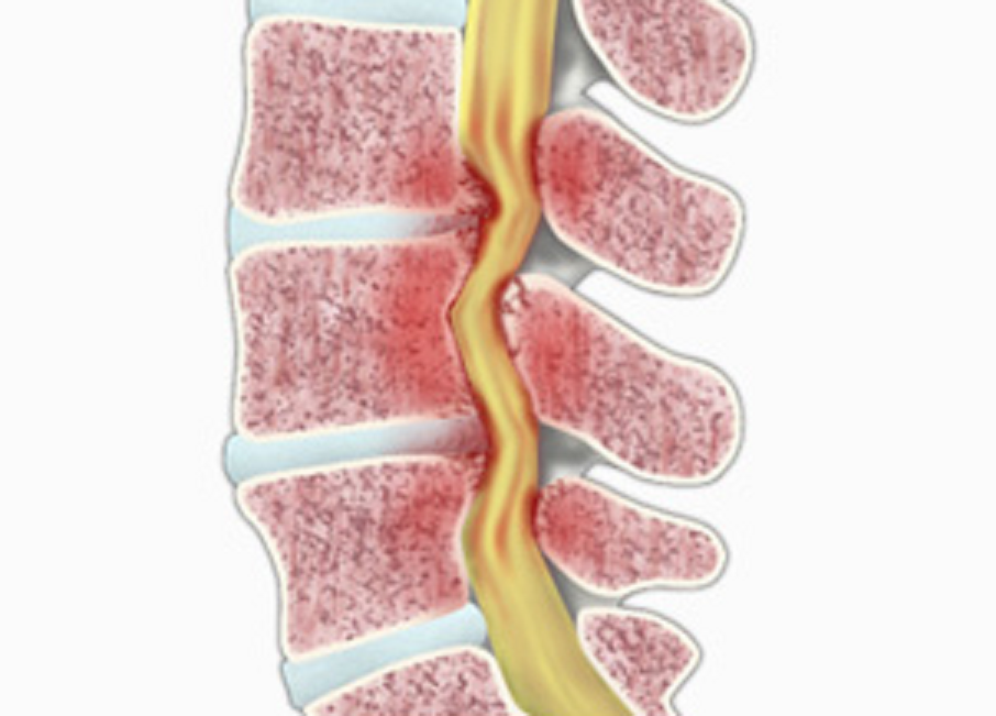 Стеноз позвоночного канала поясничного отдела. Поясничный спинальный стеноз. Стеноз позвоночного канала шейного отдела позвоночника. Стеноз позвоночного канала л3 л5. Крестцовый стеноз
