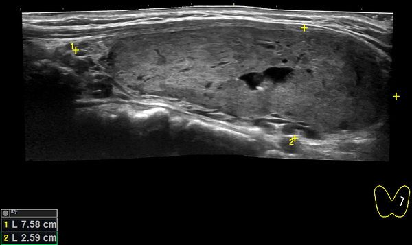 4-й урок по УЗИ щитовидной для Пациентов. Узлы.