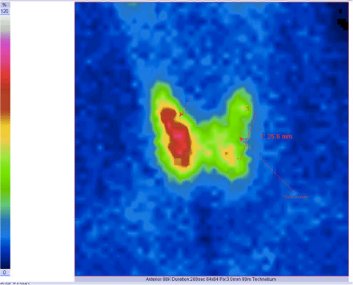 Когда нужна Сцинтиграфия щитовидной железы?
