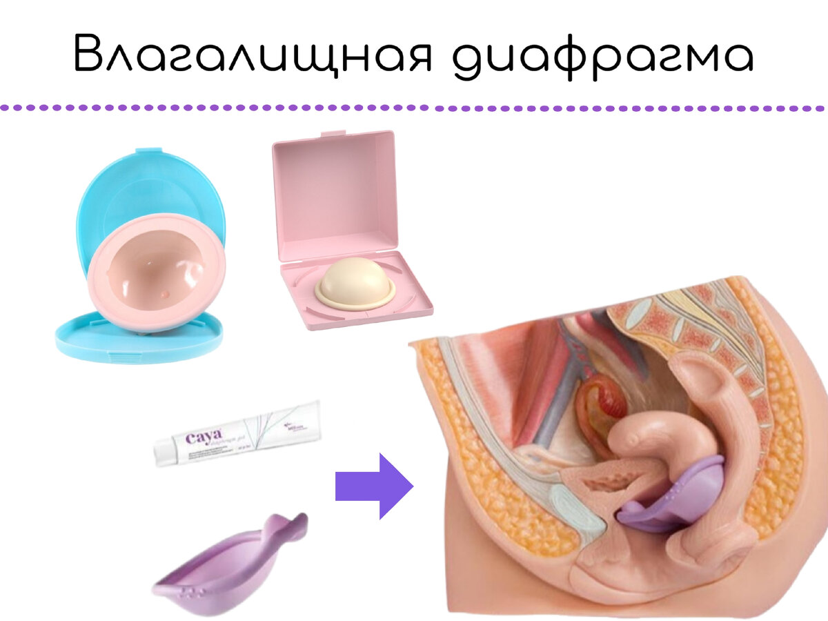 Виды и методы контрацепции