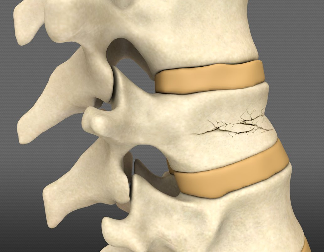 компрессионный перелом позвоночника th12 l3. что такое компрессионный перелом. что такое компрессионный перелом. компрессионный перелом позвоночника th11-l1. компрессионный перелом th5 позвонка.