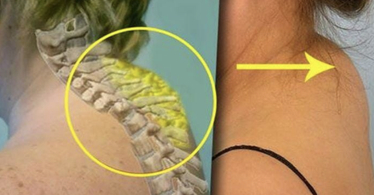 Никакого отношения к жиру холка не имеет. В моей практике она уходила и у клиенток с выраженным лишним весом при регулярных занятиях пилатесом. Фото: Яндекс.Картинки