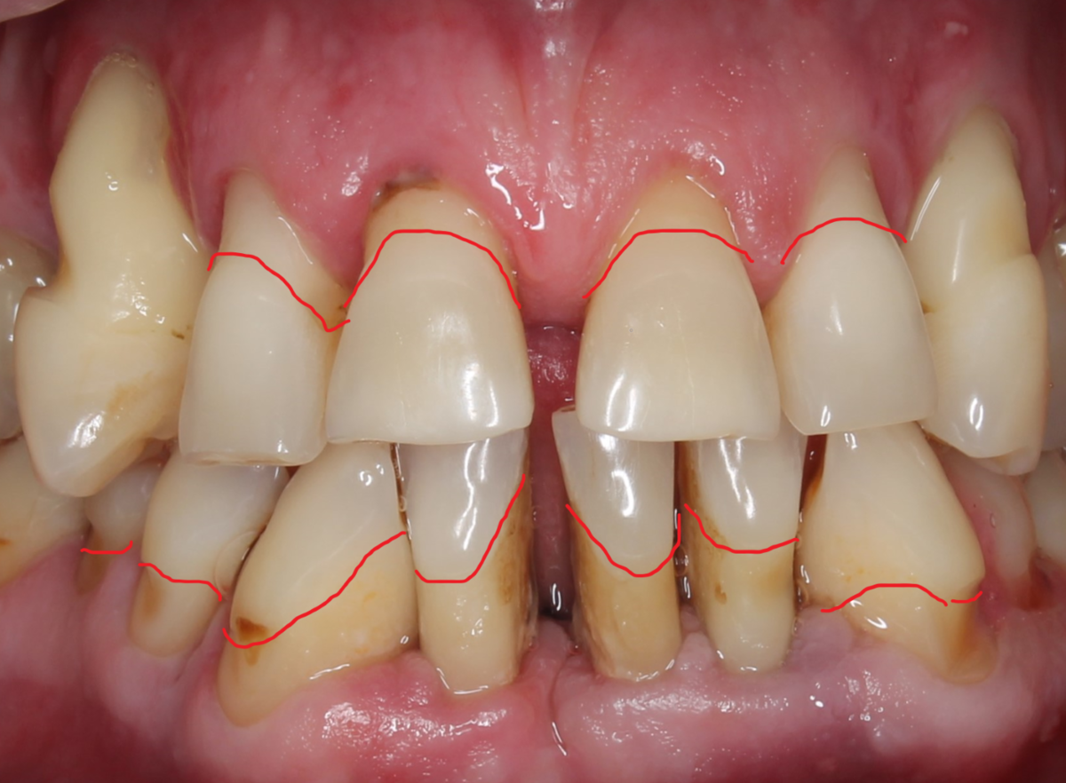Оголение корней зубов и шейки зуба