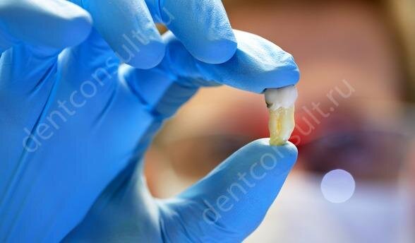 Как проходит удаление зубов мудрости. Фото: dentconsult.ru