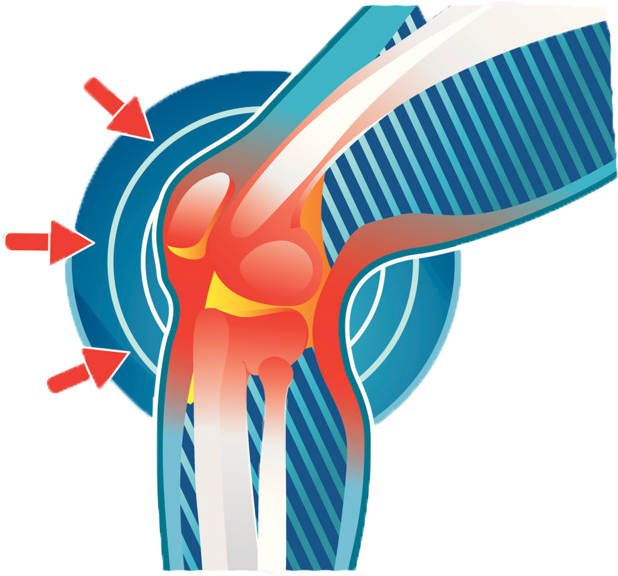 Что такое артрит
