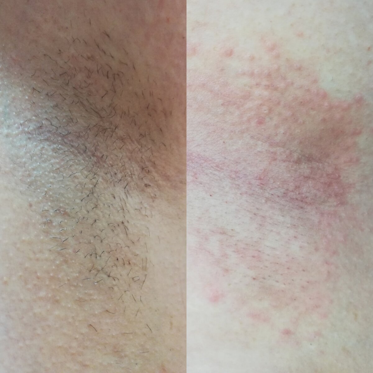 Работы @delicato_epil. Фото "после" сделано сразу после процедуры. Покраснение проходит через несколько часов