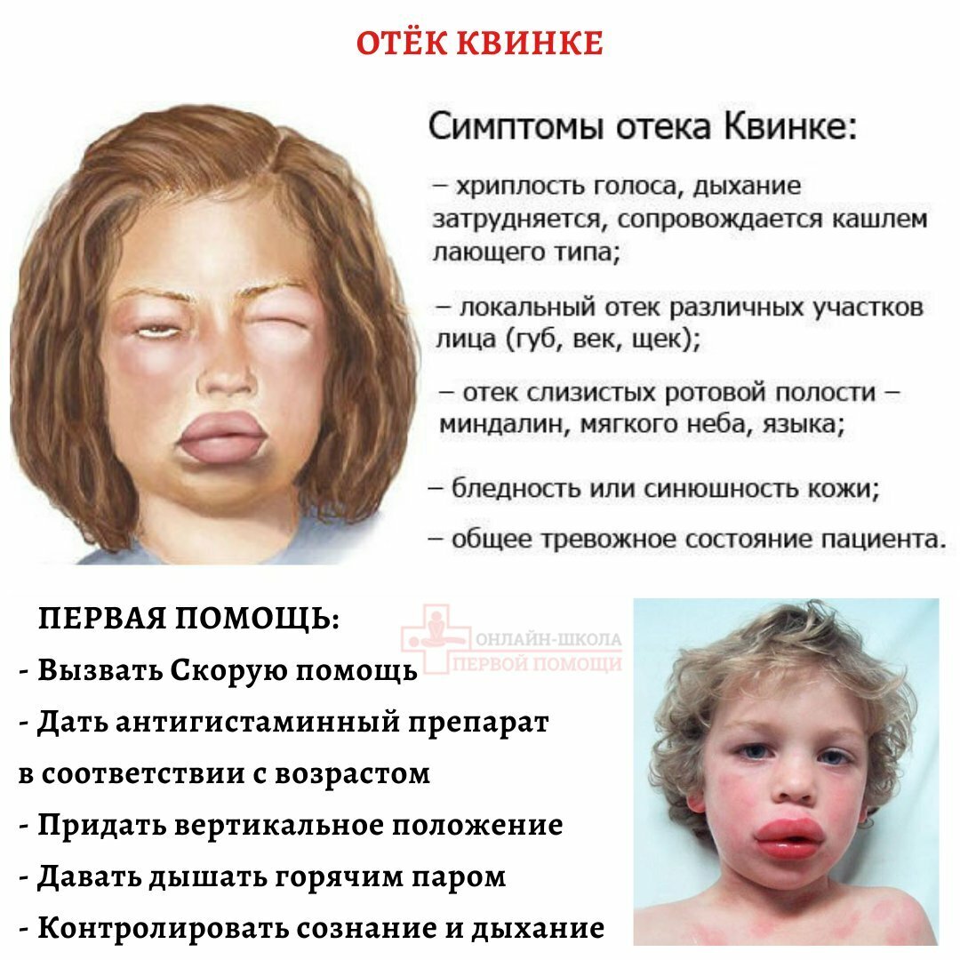 Отек Квинке