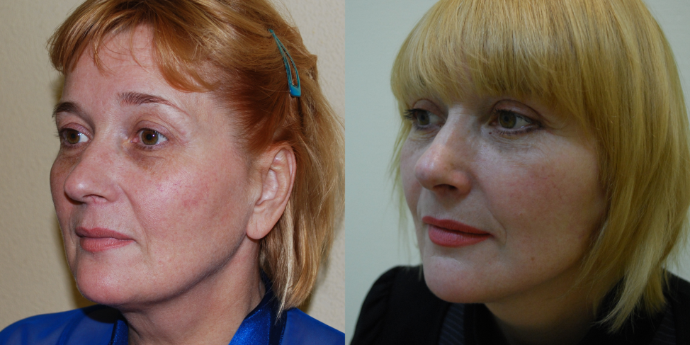 Подтяжка лица, фото с сайта Гришкяна Д.Р.