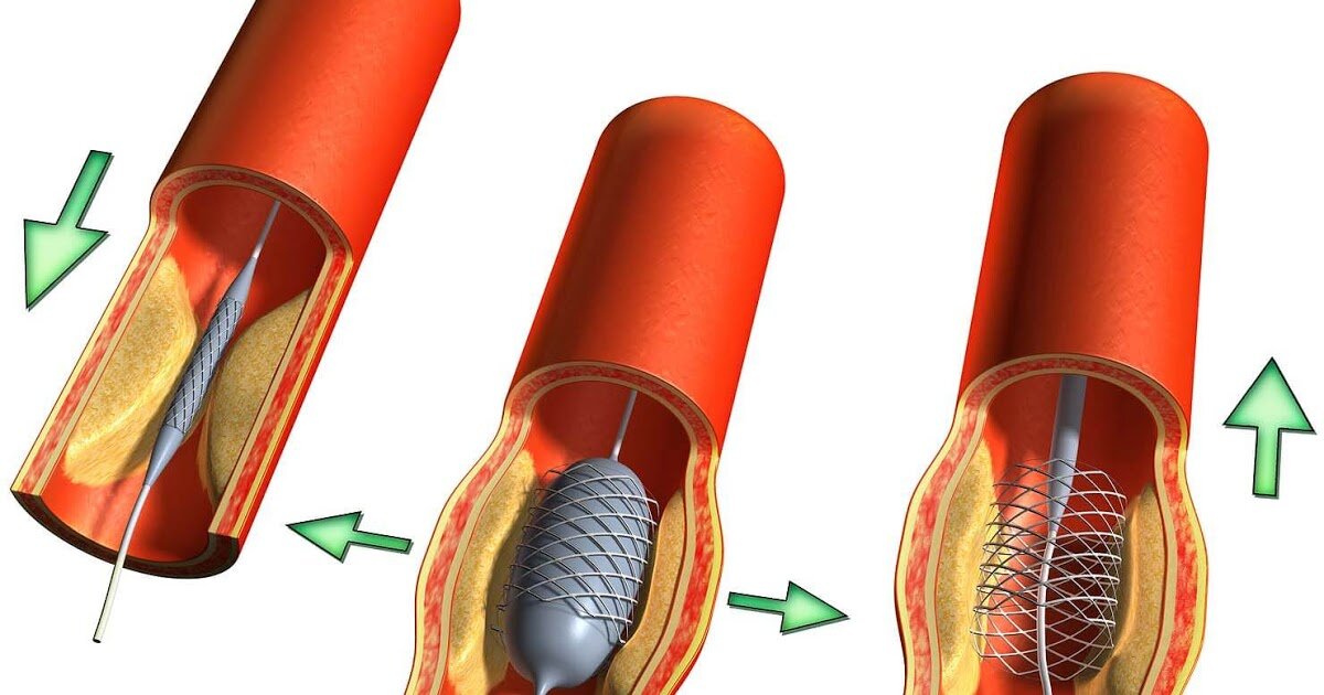 стентирование сосуда