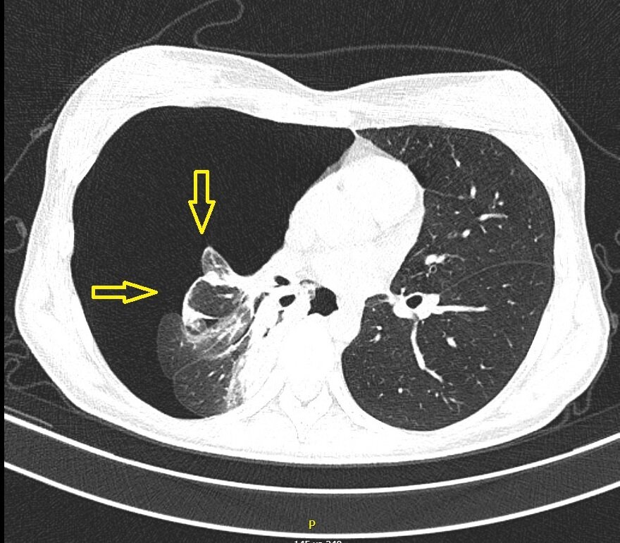На КТ органов грудной клетки стрелками отмечено спавшееся правое легкое