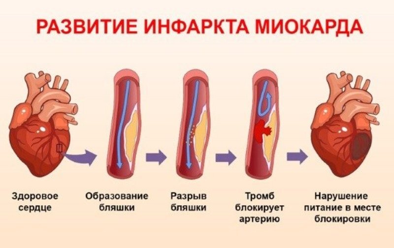 развитие инфаркта миокарда