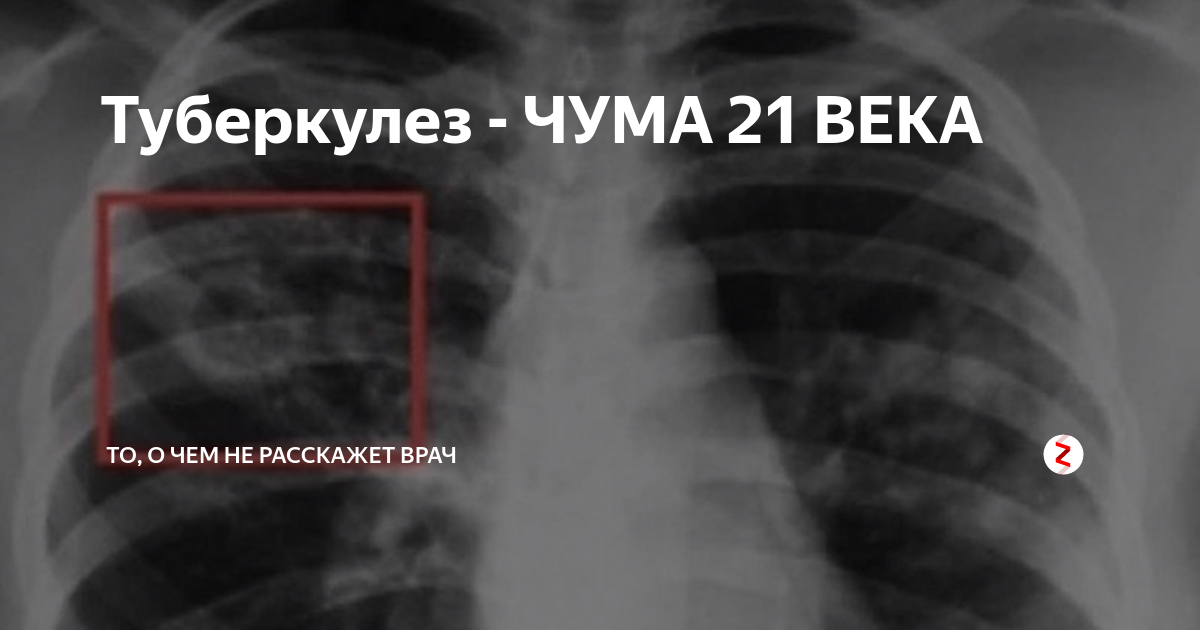 Палочка чумы возбудитель. Чума холера оспа коклюш сибирская язва столбняк. Болезни вызываемые бактериями таблица. Чума это туберкулез. Бактерии вызывают туберкулез и чуму.