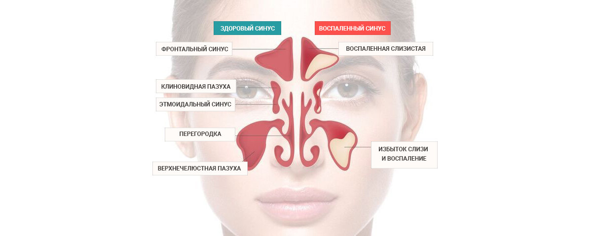 Гайморовы пазухи расположение схема. Гайморовы пазухи анатомия гайморит. Пазухи носа анатомия гайморит.