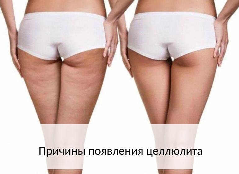 Причина целлюлита