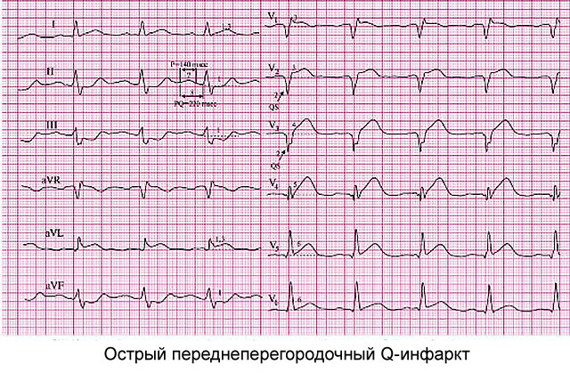 ЭКГ-признаки ишемии миокарда