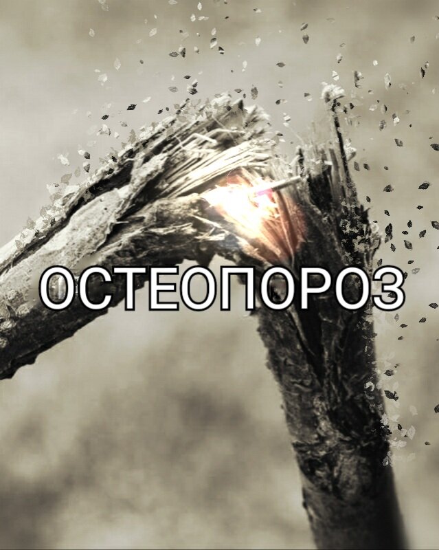 Остеопороз