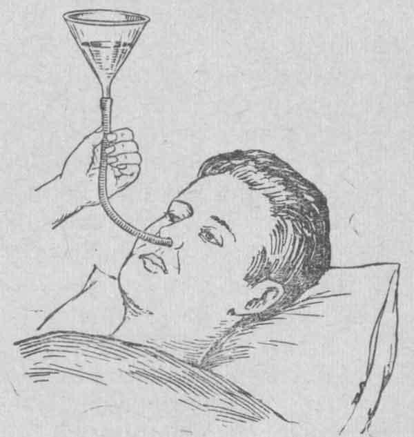 Питание через назальный зонд.