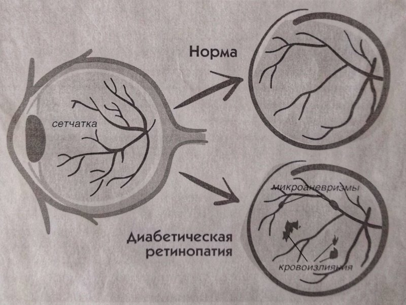 При повышенном сахаре страдают мелкие сосуды сетчатки