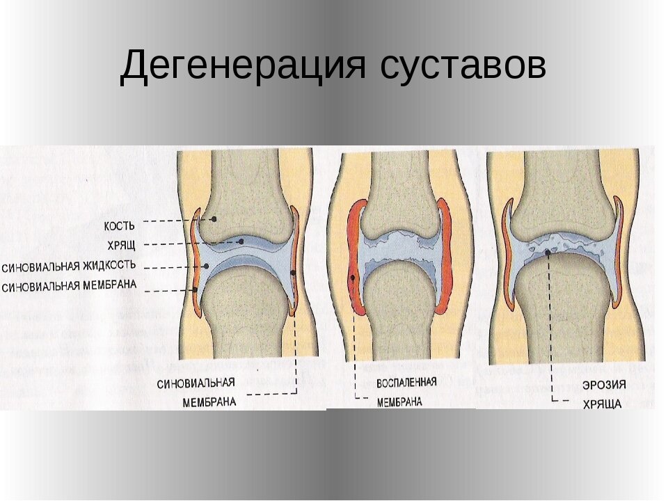 Изменение суставов. Дегенеративные изменения суставов. Суставной хрящ.