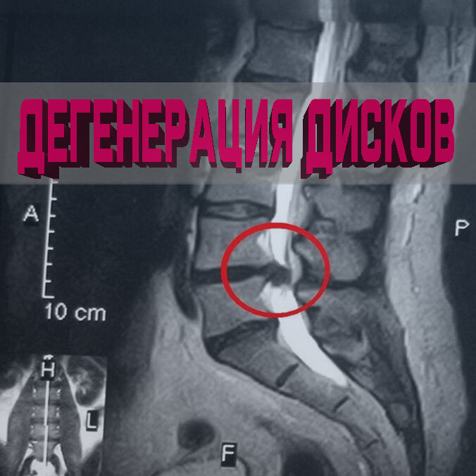 Дегенерация 3 степени