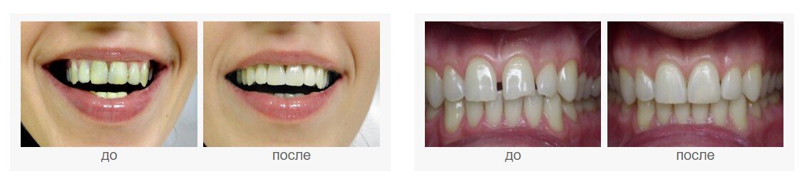 Результат реставрации. Восстановление передних зубов. Восстановление эмали передних зубов.