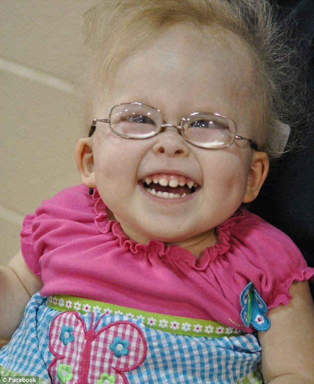 Ребенок с синдромом Конради-Хюнерманна