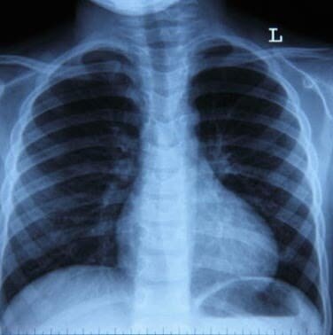 КТ легких Рентген легких