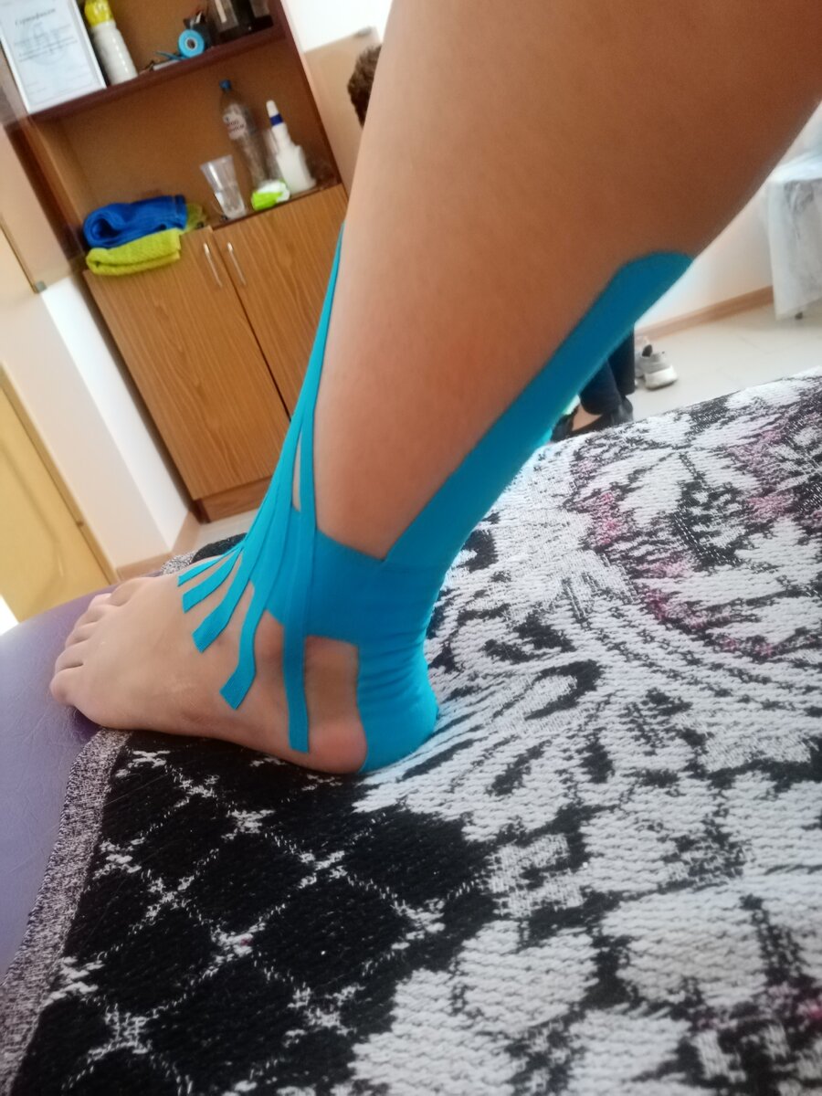 Кинезиотейпирование ушибленной стопы