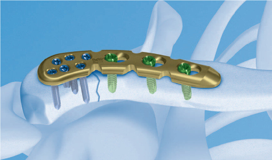 Установка пластин при переломах ключицы