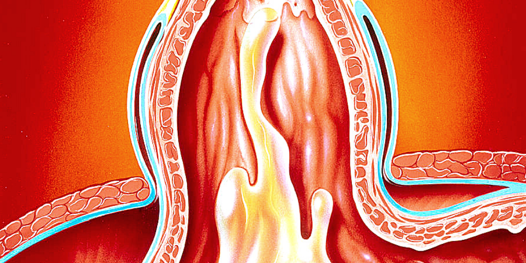 Заброс  содержимого желудка в пищевод.