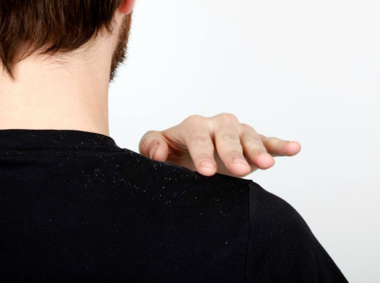 Скажите перхоти нет