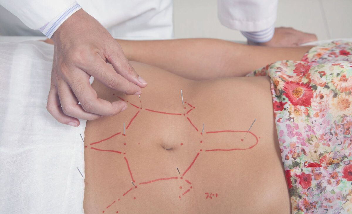 Иглоукалывание в лечении бесплодия