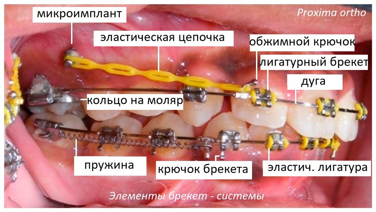 Элементы брекет - системы