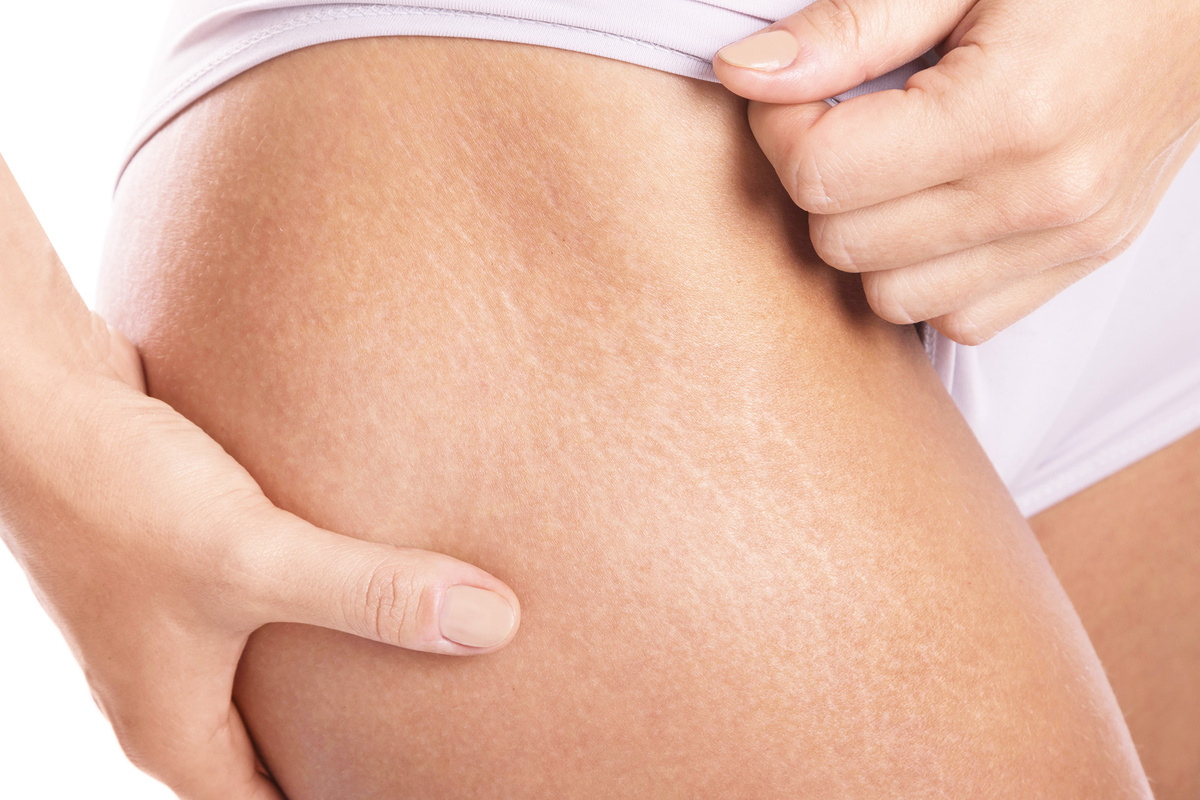 Растяжки — неприятное явление, с которыми сталкиваются многие женщины. Растяжка может быть розового, синего, фиолетового цвета или беловатого, напоминая рубец.